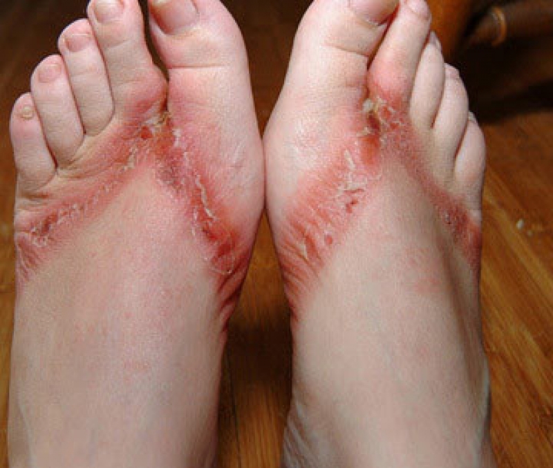 Dermatite de Contato