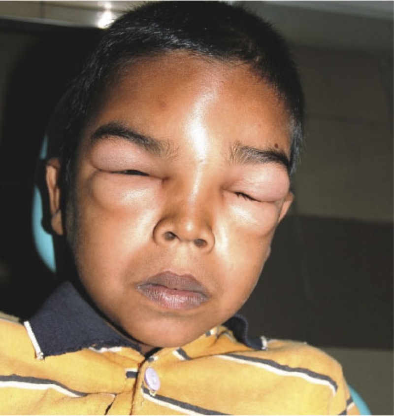Angioedema